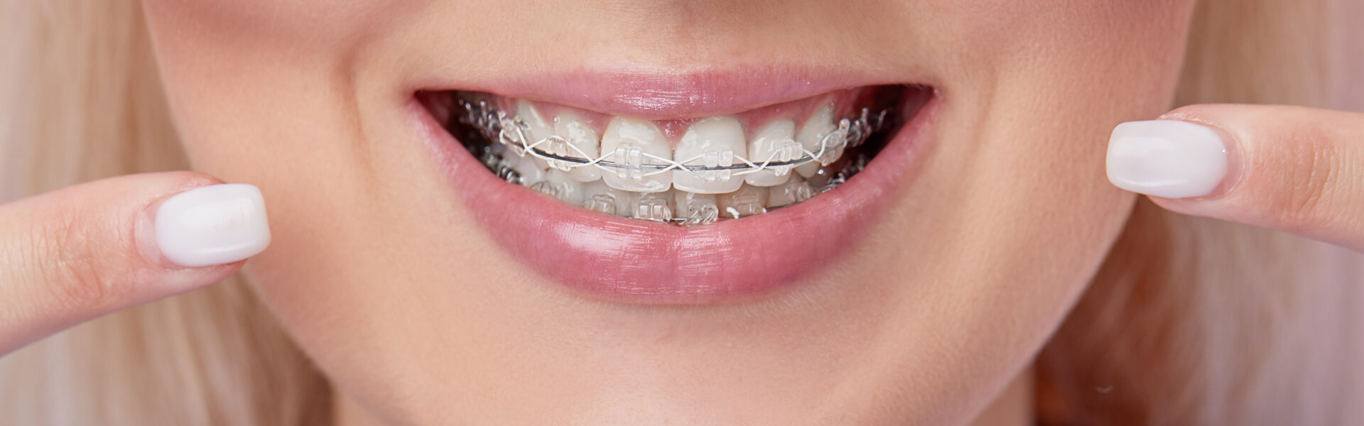 Clear Braces in Dover, NH Belknap Dental Associates
